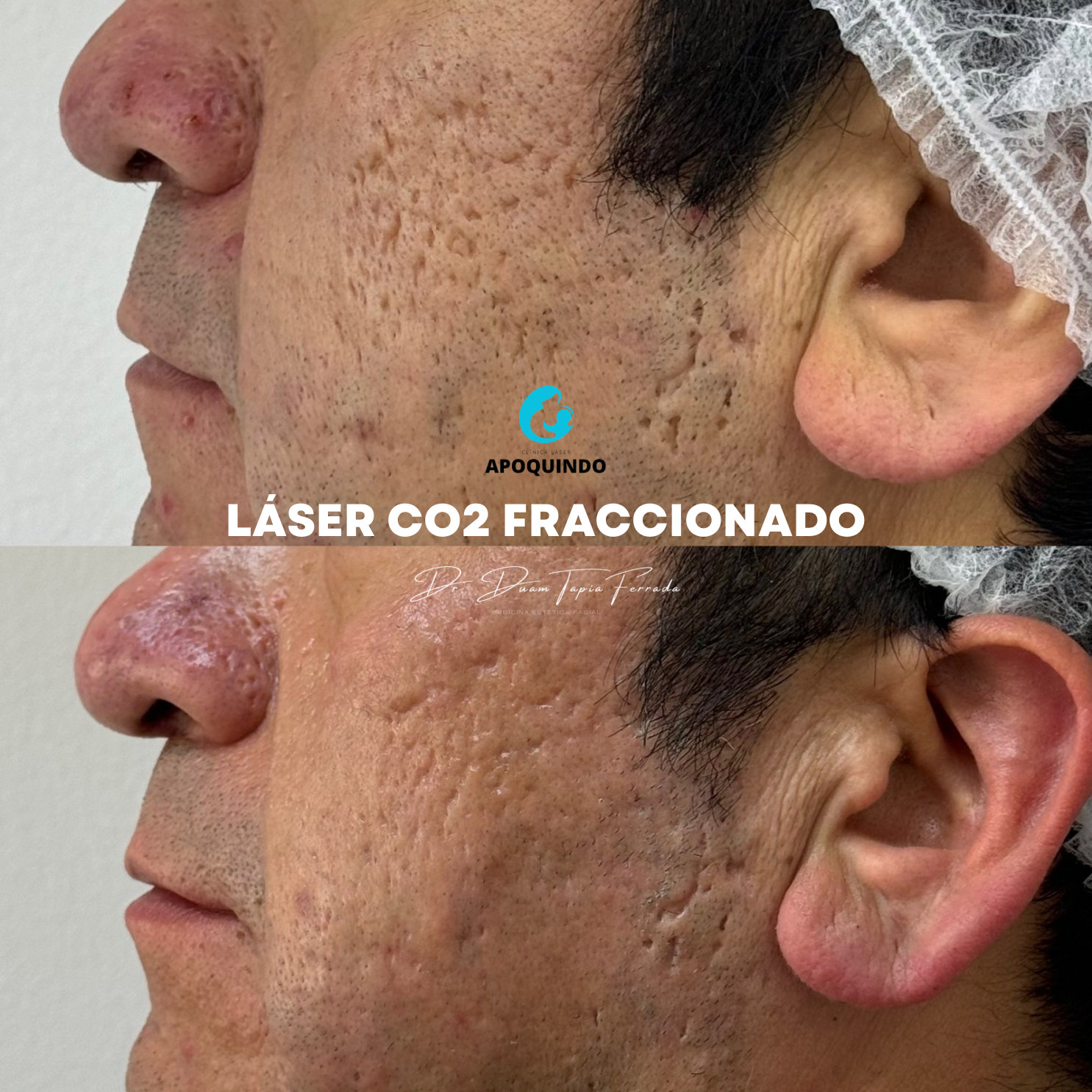 Láser CO₂ Fraccionado